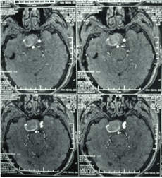 經(jīng)顱多普勒
