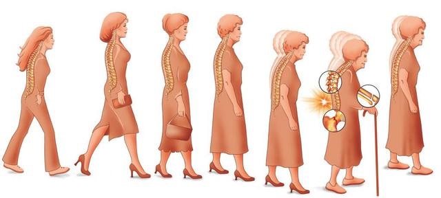 一分鐘測(cè)試題目評(píng)估你的骨質(zhì)疏松癥風(fēng)險(xiǎn)